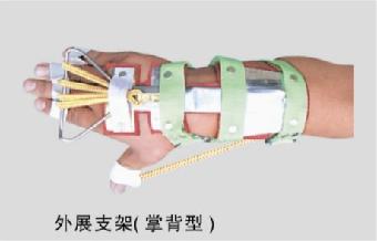 QYJ-08外展支架(掌背型)